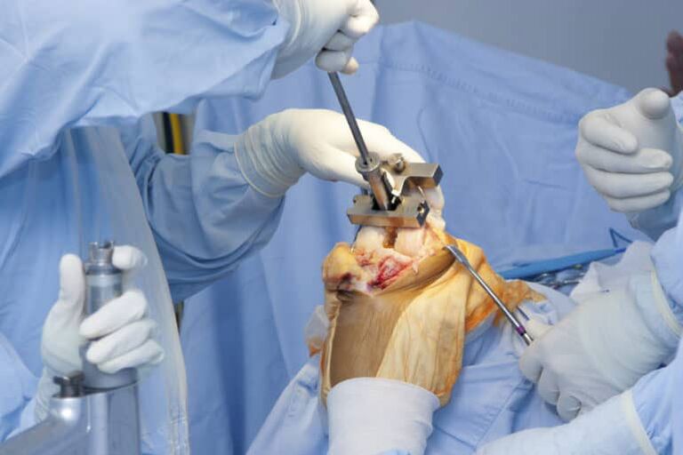 chirurgie arthrose du genou