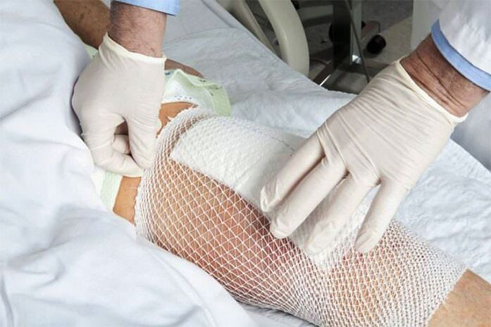 Compresse thérapeutique pour l'arthrose de l'articulation du genou