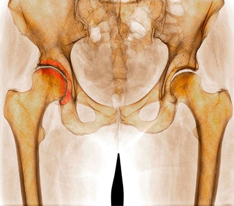 inflammation de l'articulation de la hanche comme cause de douleur