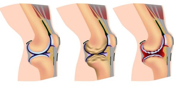 Étapes de déformation de l'articulation du genou