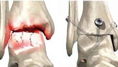 Traitement chirurgical de l'arthrose du genou