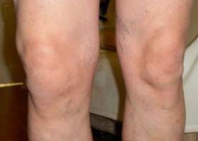symptômes du genou