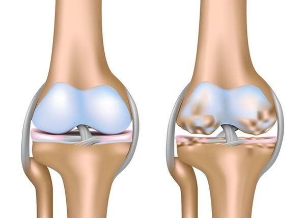 arthrose