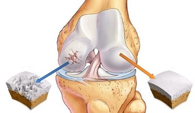 Les raisons du développement de l'arthrose des articulations