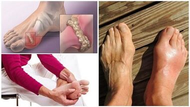 Qu'est-ce que l'arthrite des articulations