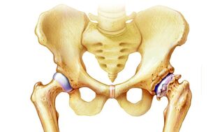 pourquoi l'arthrose de l'articulation de la hanche se produit
